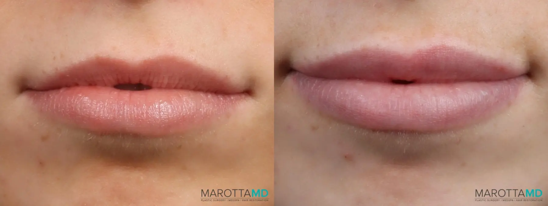 Filler - Lips: Patient 3 - Before and After  