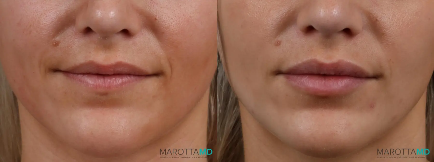 Filler - Lips: Patient 4 - Before and After  