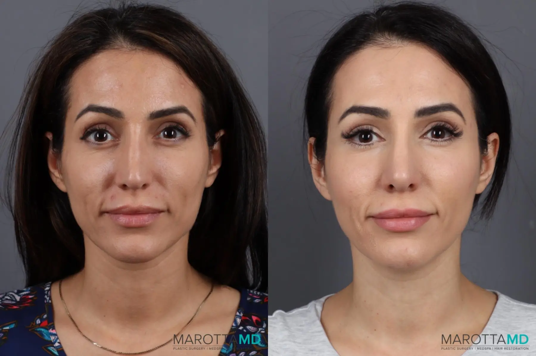 Filler - Lips: Patient 5 - Before and After  