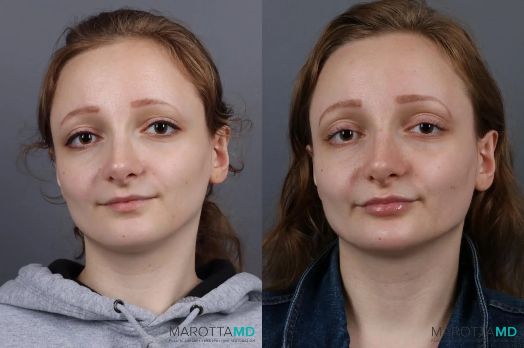 Fillers: Patient 3 - Before and After  