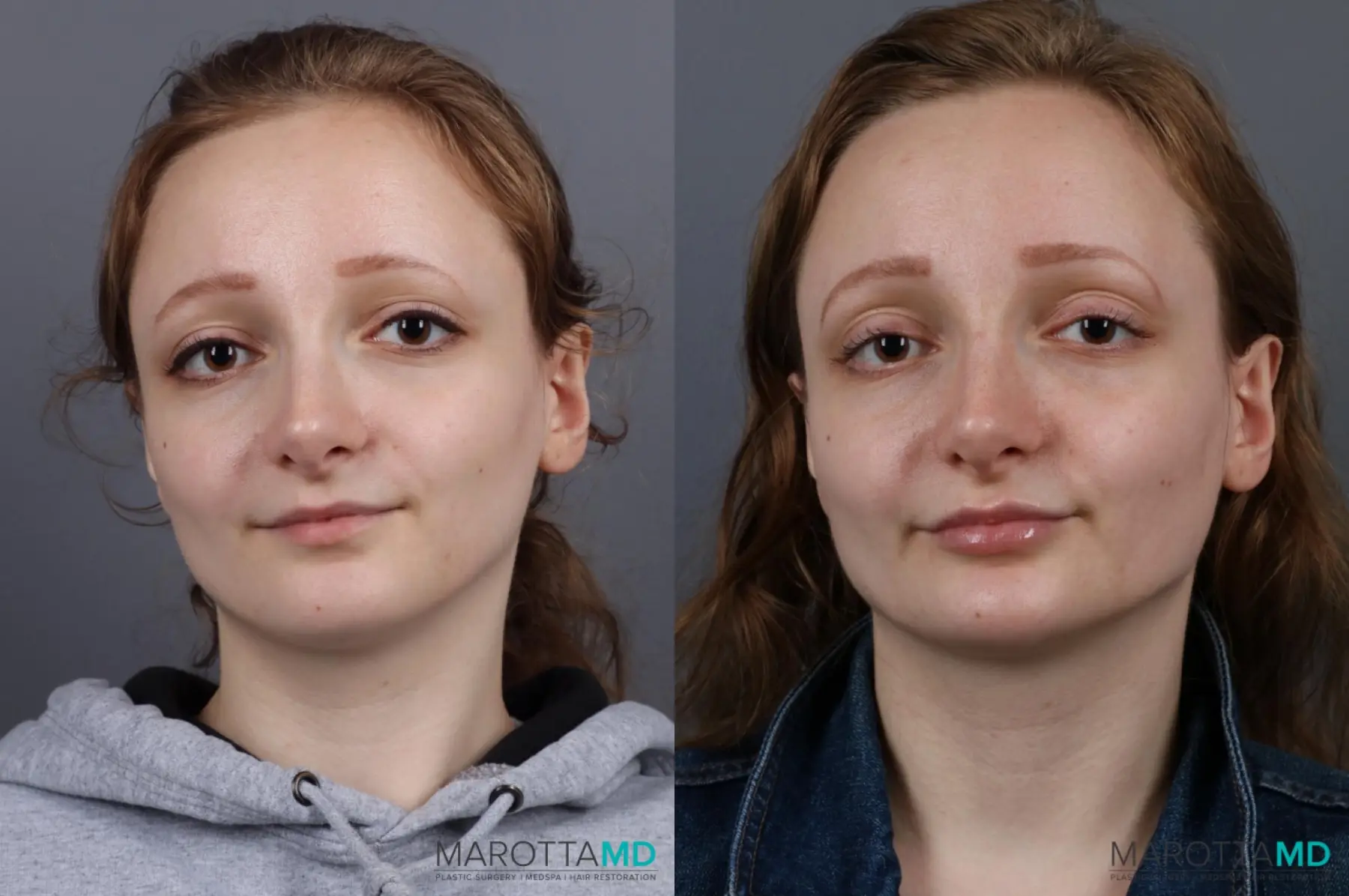 Fillers: Patient 2 - Before and After  