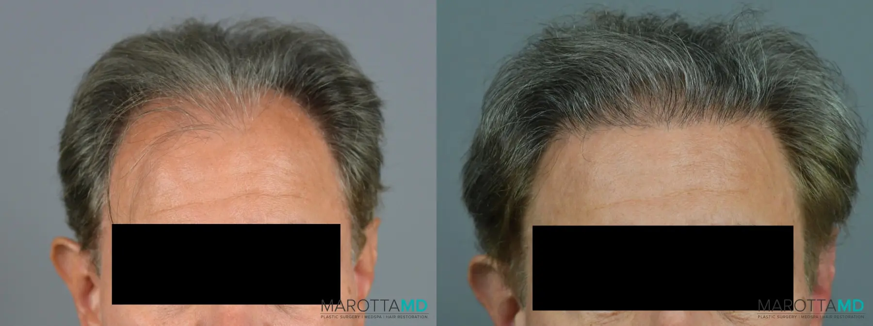 Hair Transplantation: Patient 4 - Before and After  