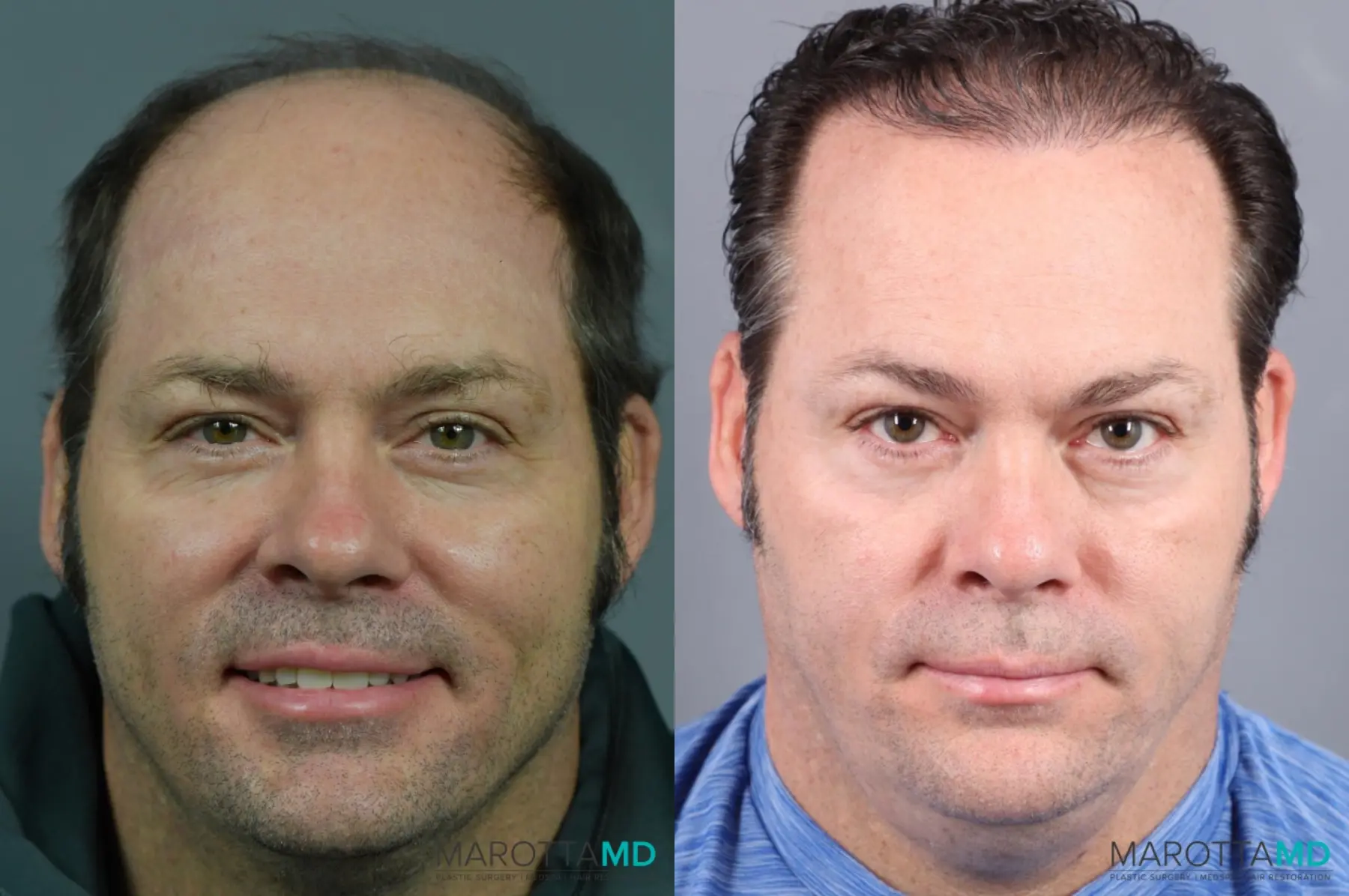 Hair Transplantation: Patient 2 - Before and After  