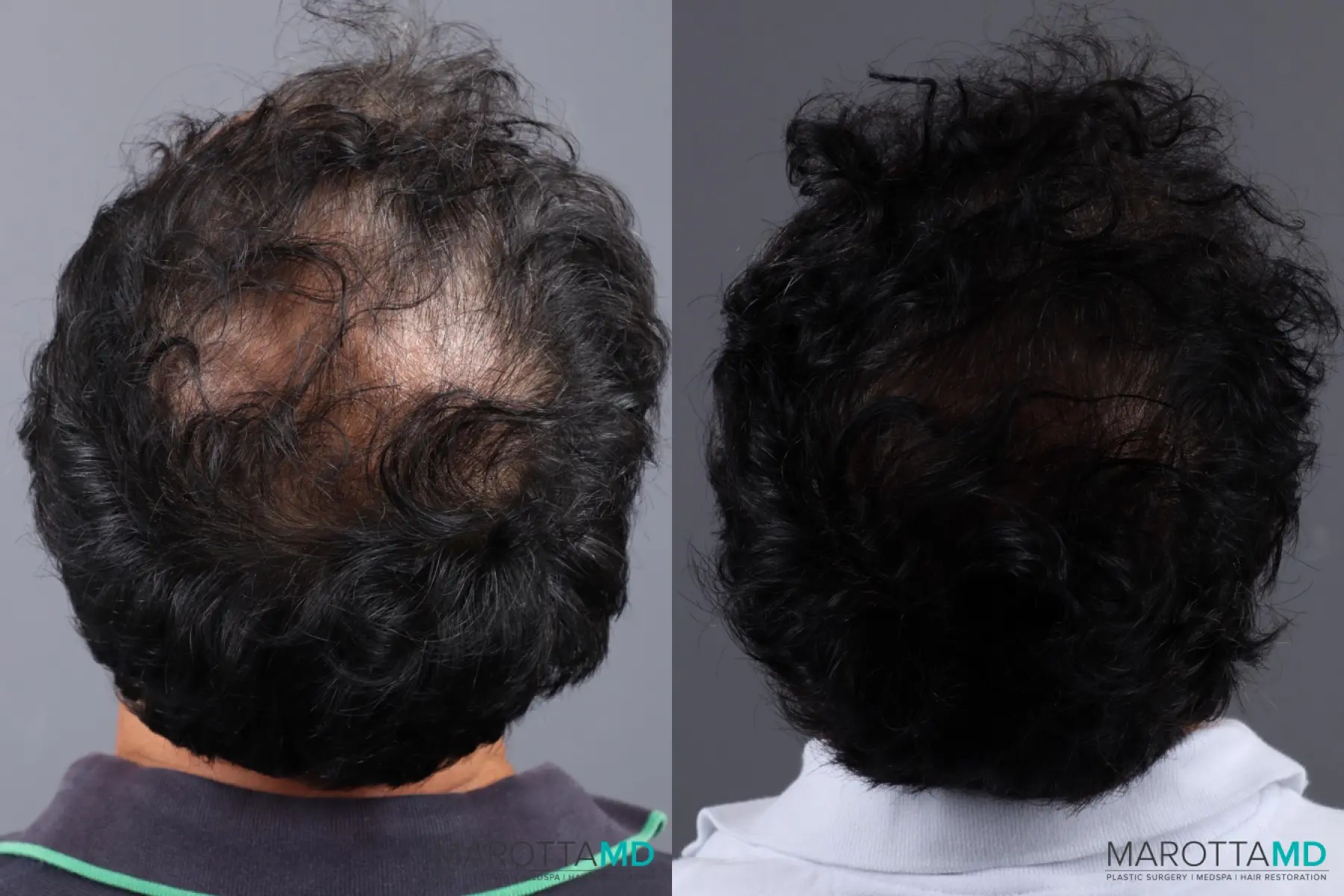 Hair Transplantation: Patient 1 - Before and After  