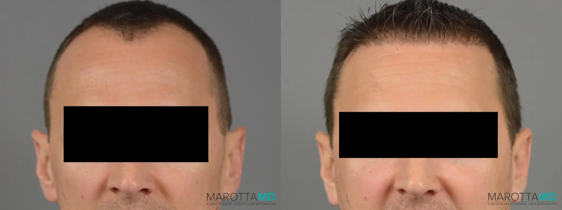 Hair Transplantation: Patient 3 - Before and After  