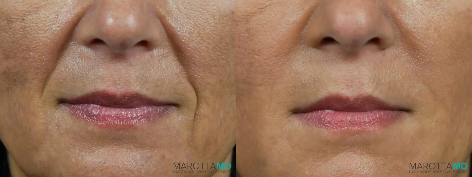 Juvederm / Fillers: Patient 1 - Before and After  