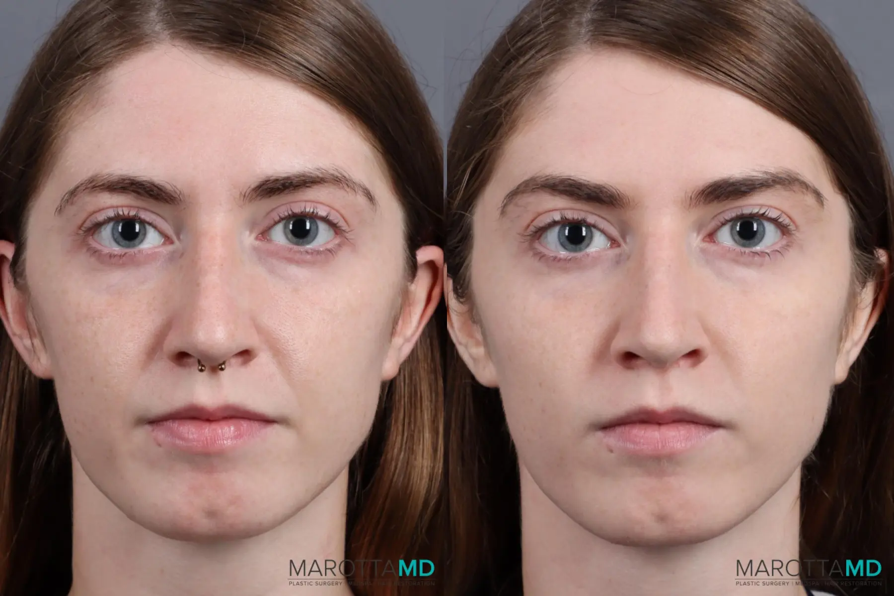 Juvederm / Fillers: Patient 2 - Before and After  