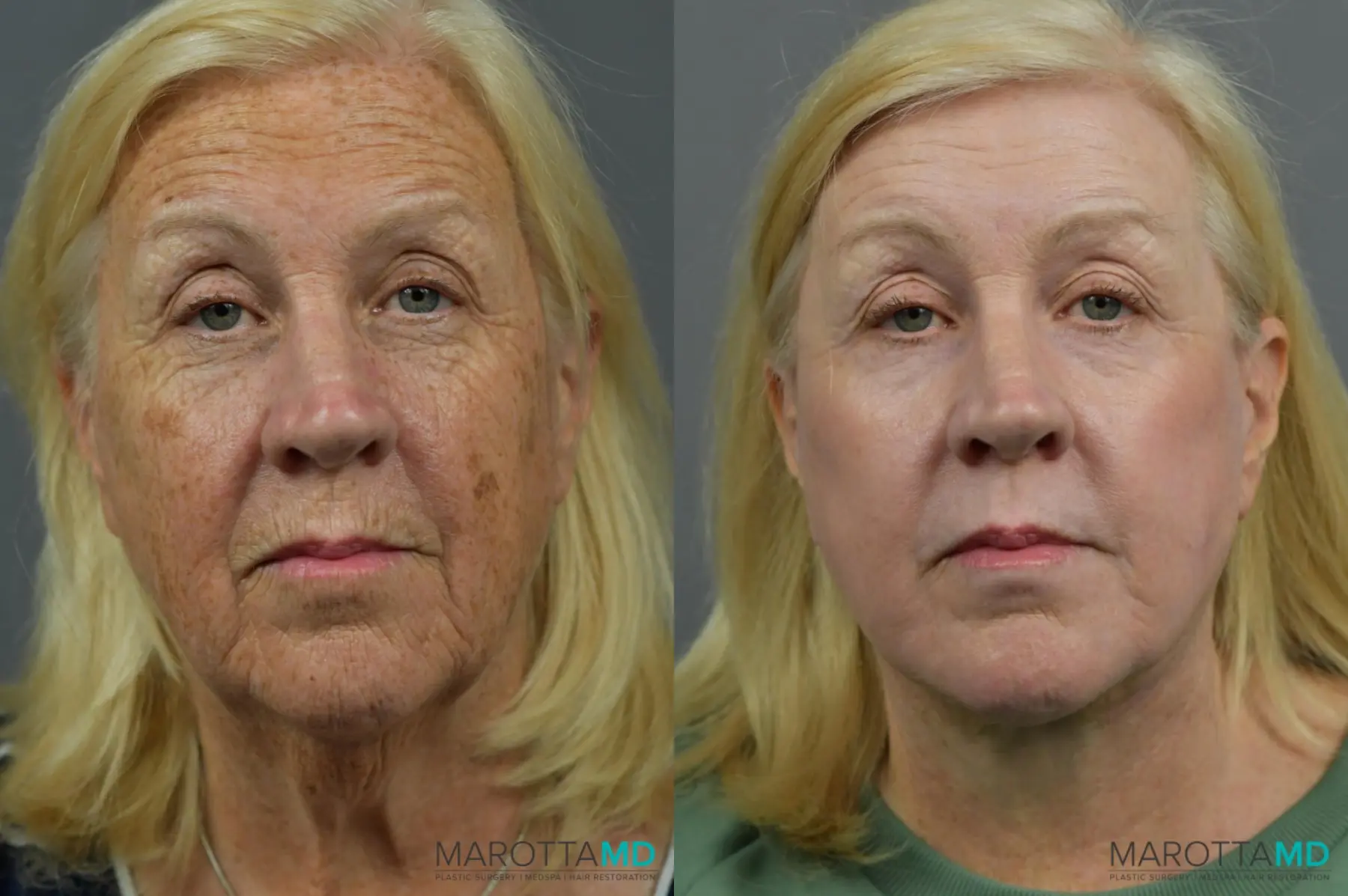 Laser Skin Resurfacing - Face: Patient 3 - Before and After  