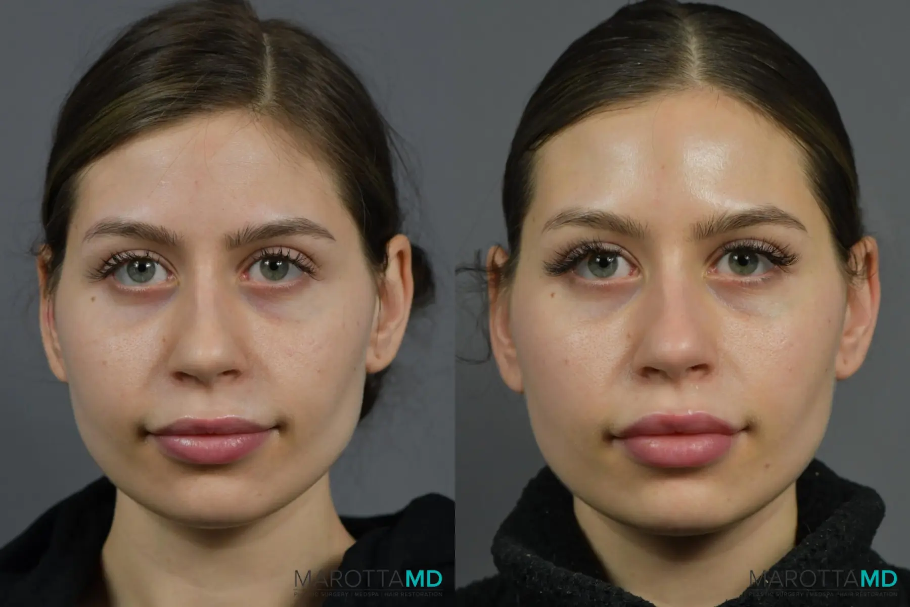 Lip Filler: Patient 2 - Before and After  