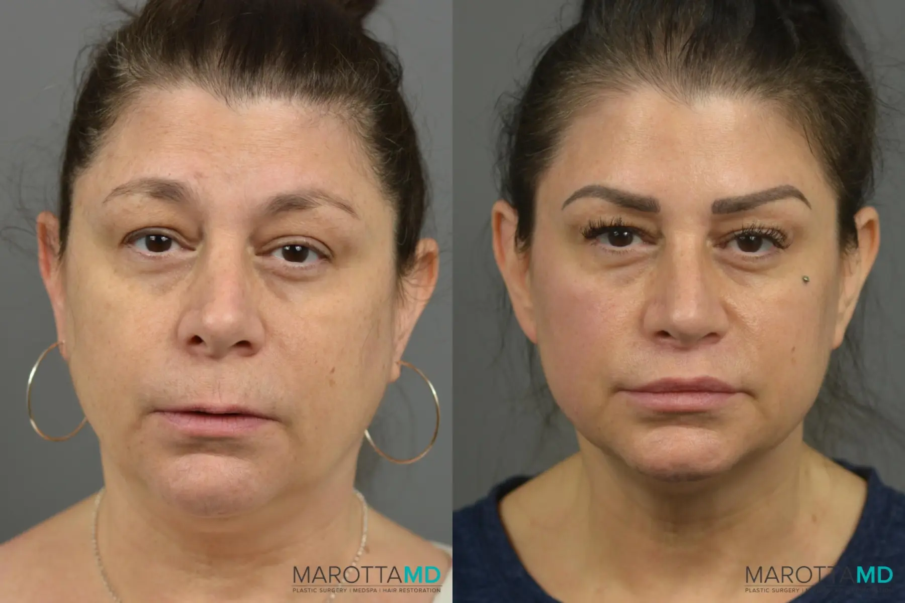 Lip Lift: Patient 2 - Before and After  