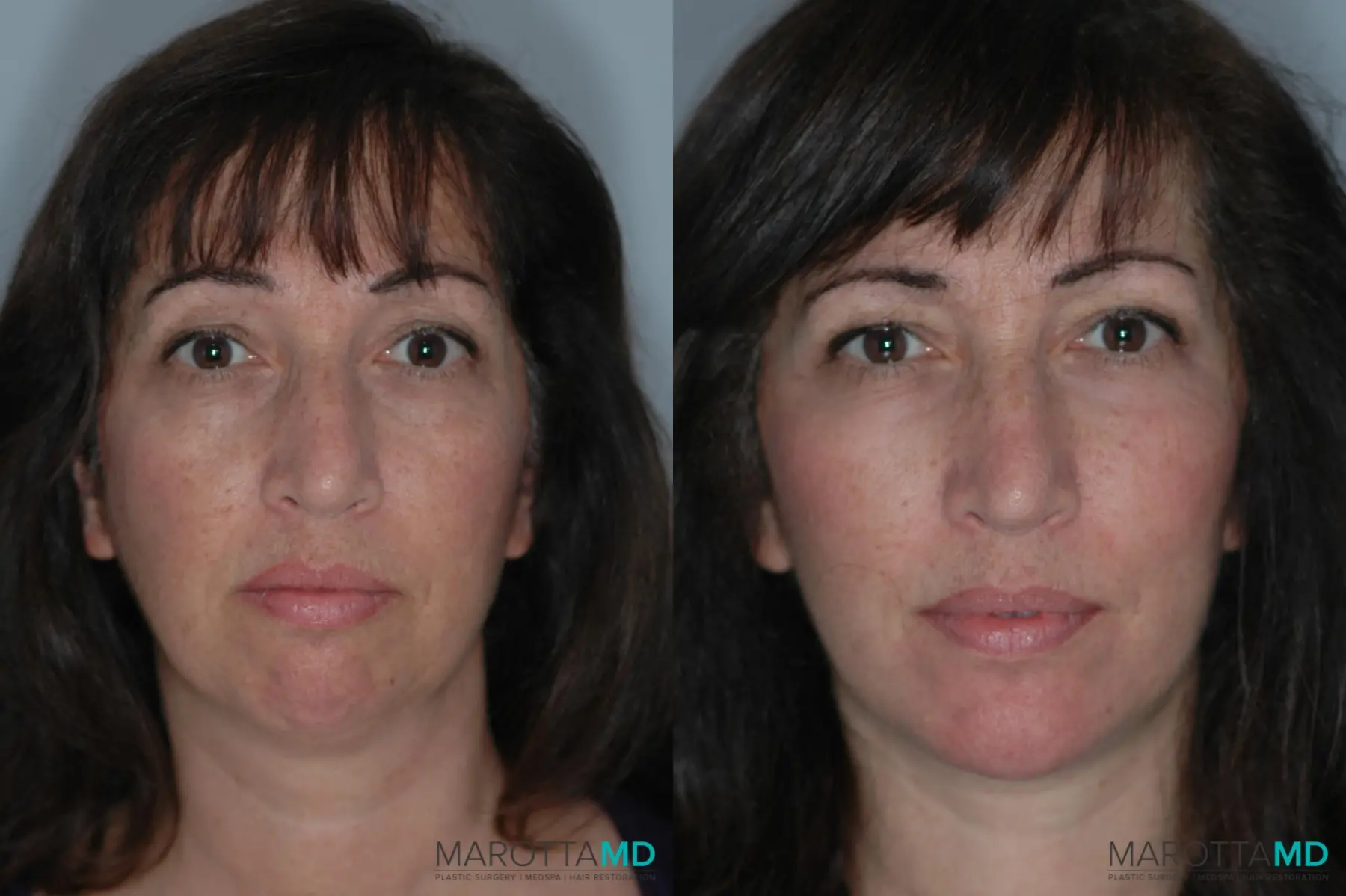 Liposuction Of The Neck: Patient 3 - Before and After  