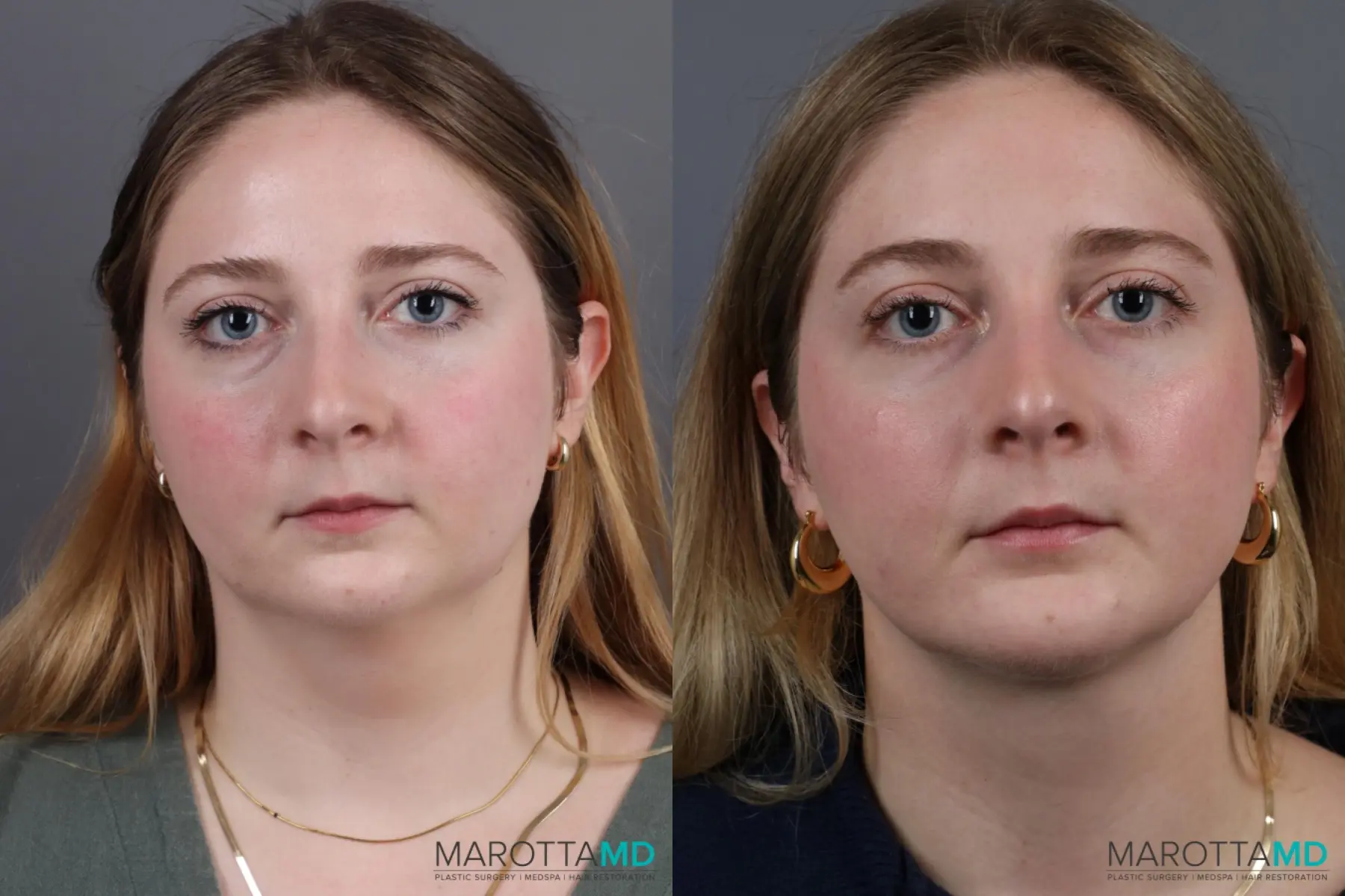 Liposuction Of The Neck: Patient 4 - Before and After  