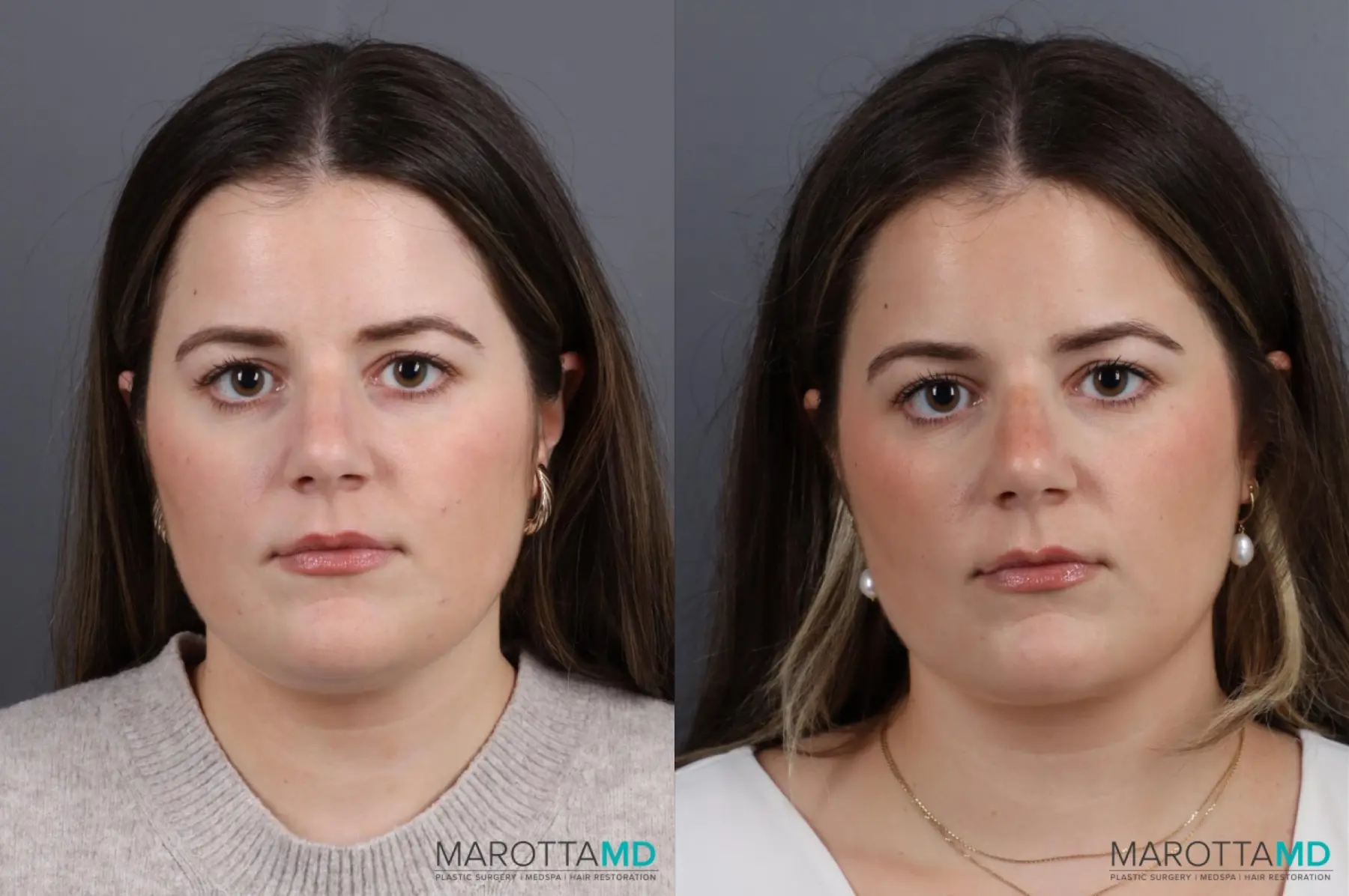 Liposuction Of The Neck: Patient 1 - Before and After  