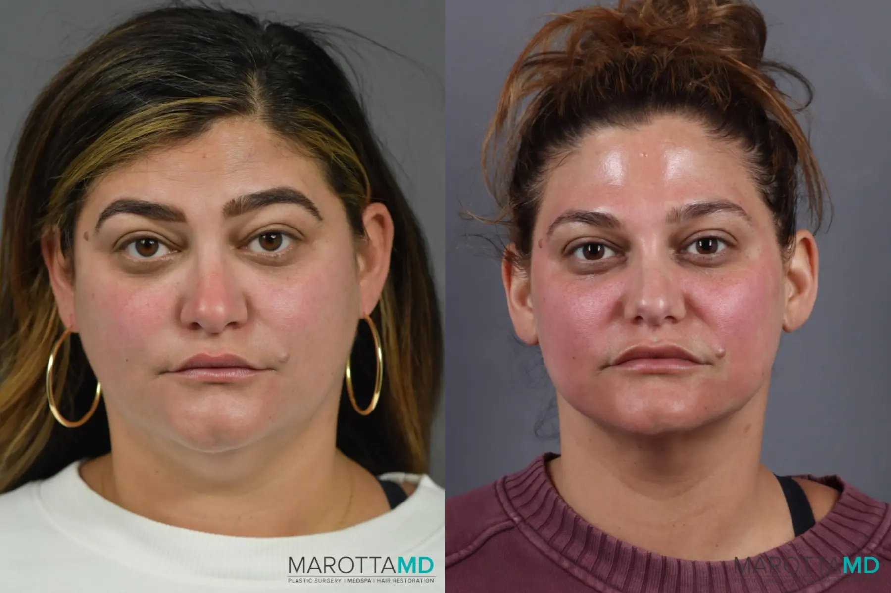 Liposuction Of The Neck: Patient 1 - Before and After  