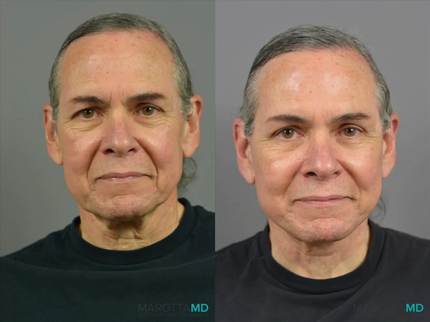 Mini Facelift: Patient 4 - Before and After  