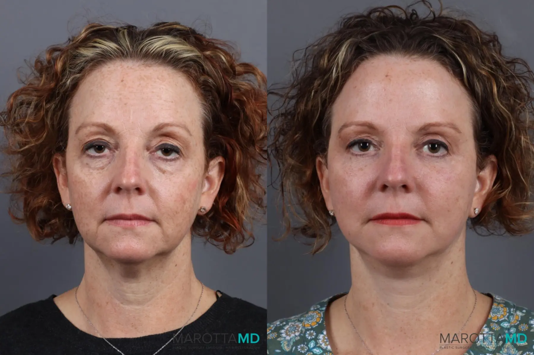 Mini Facelift: Patient 2 - Before and After  