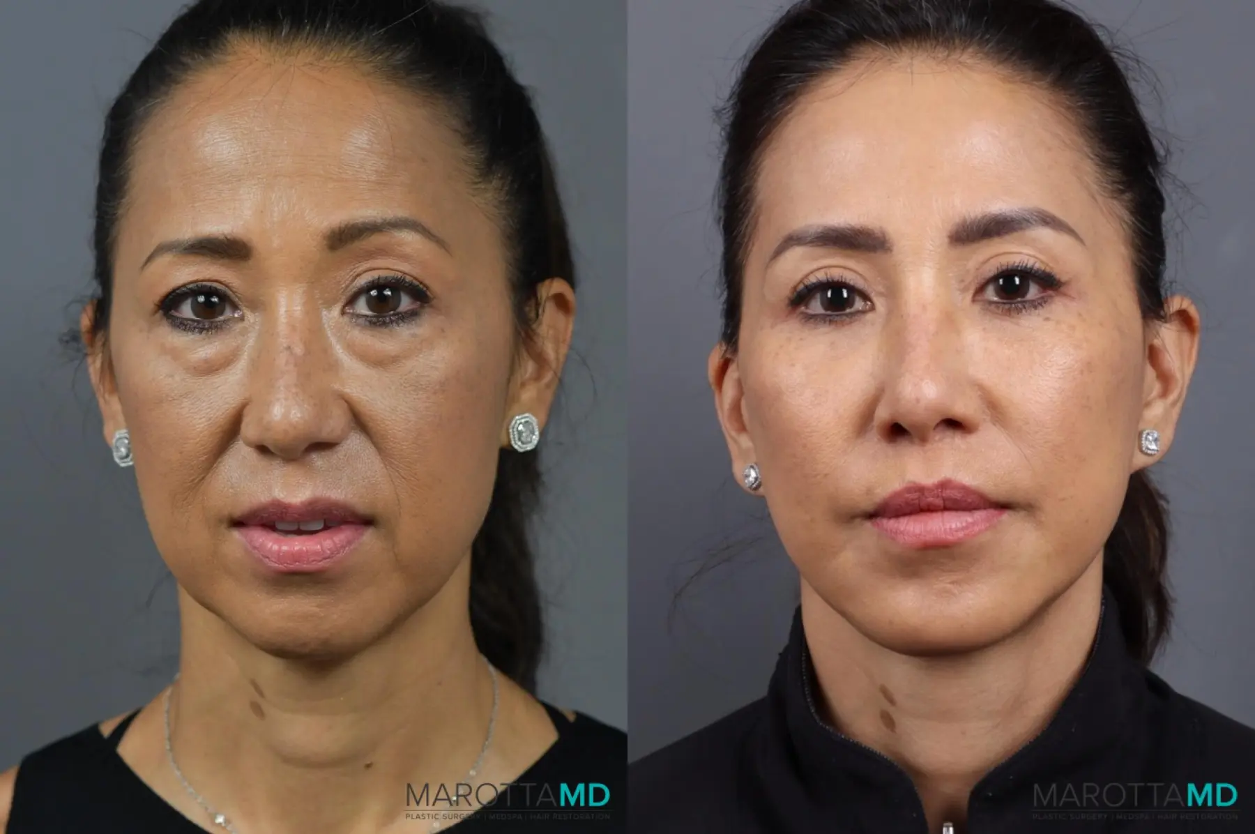 Mini Facelift: Patient 1 - Before and After  