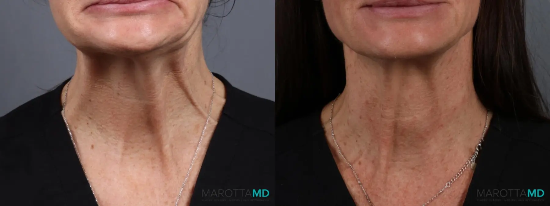 Botox - Nefertiti Neck Lift: Patient 1 - Before and After  