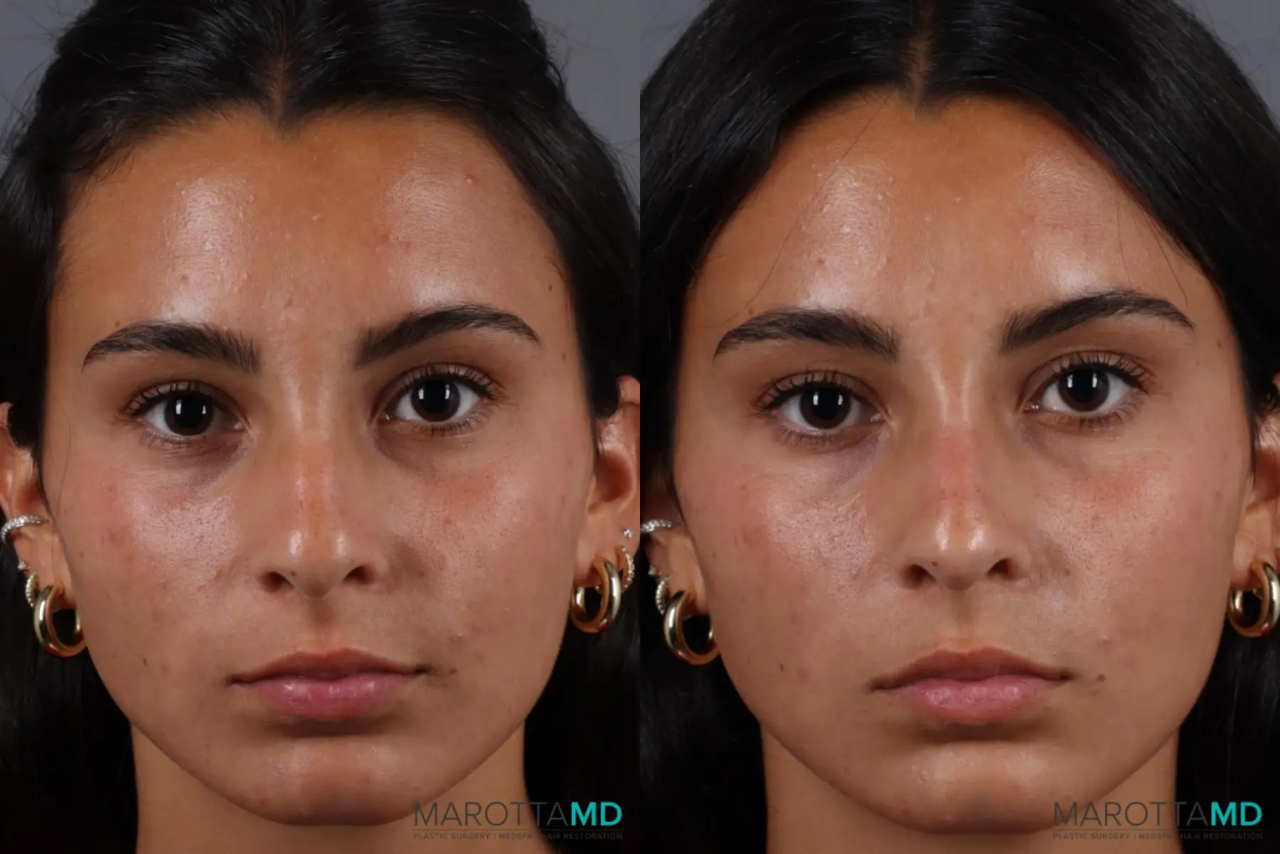 Non-Surgical Rhinoplasty: Patient 1 - Before and After  