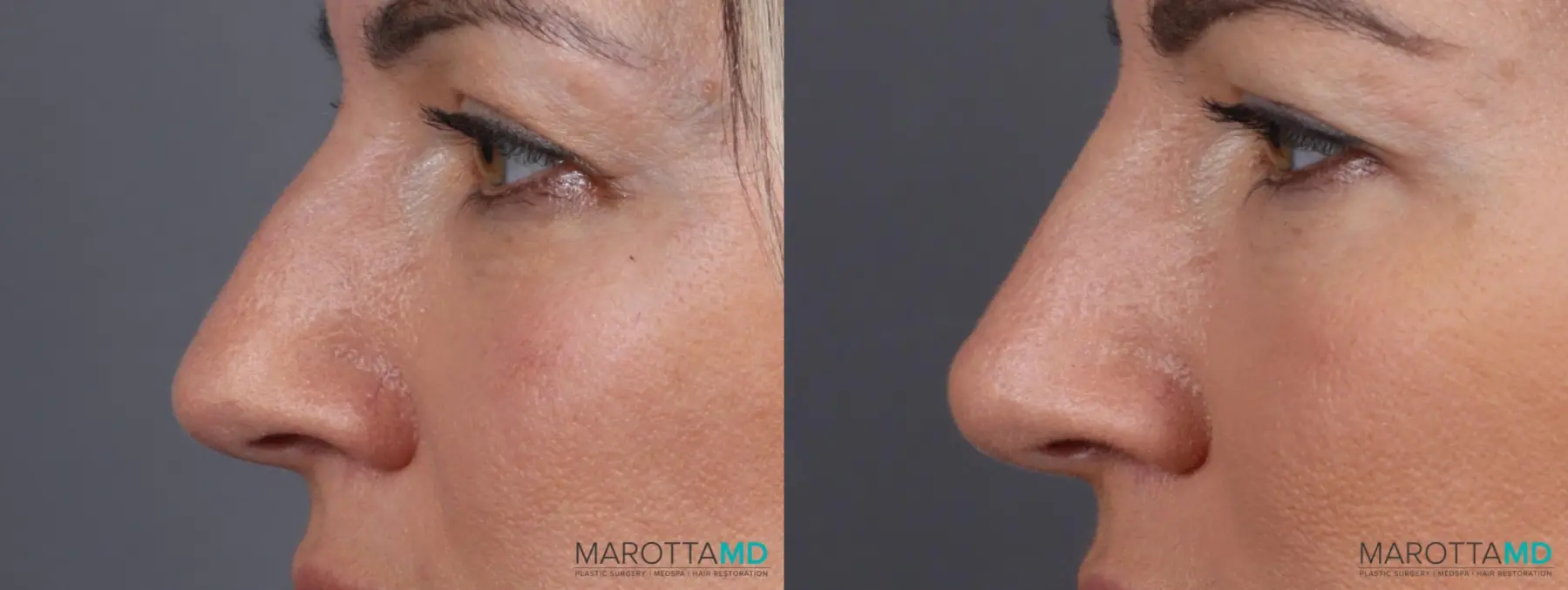 Non-Surgical Rhinoplasty: Patient 2 - Before and After  