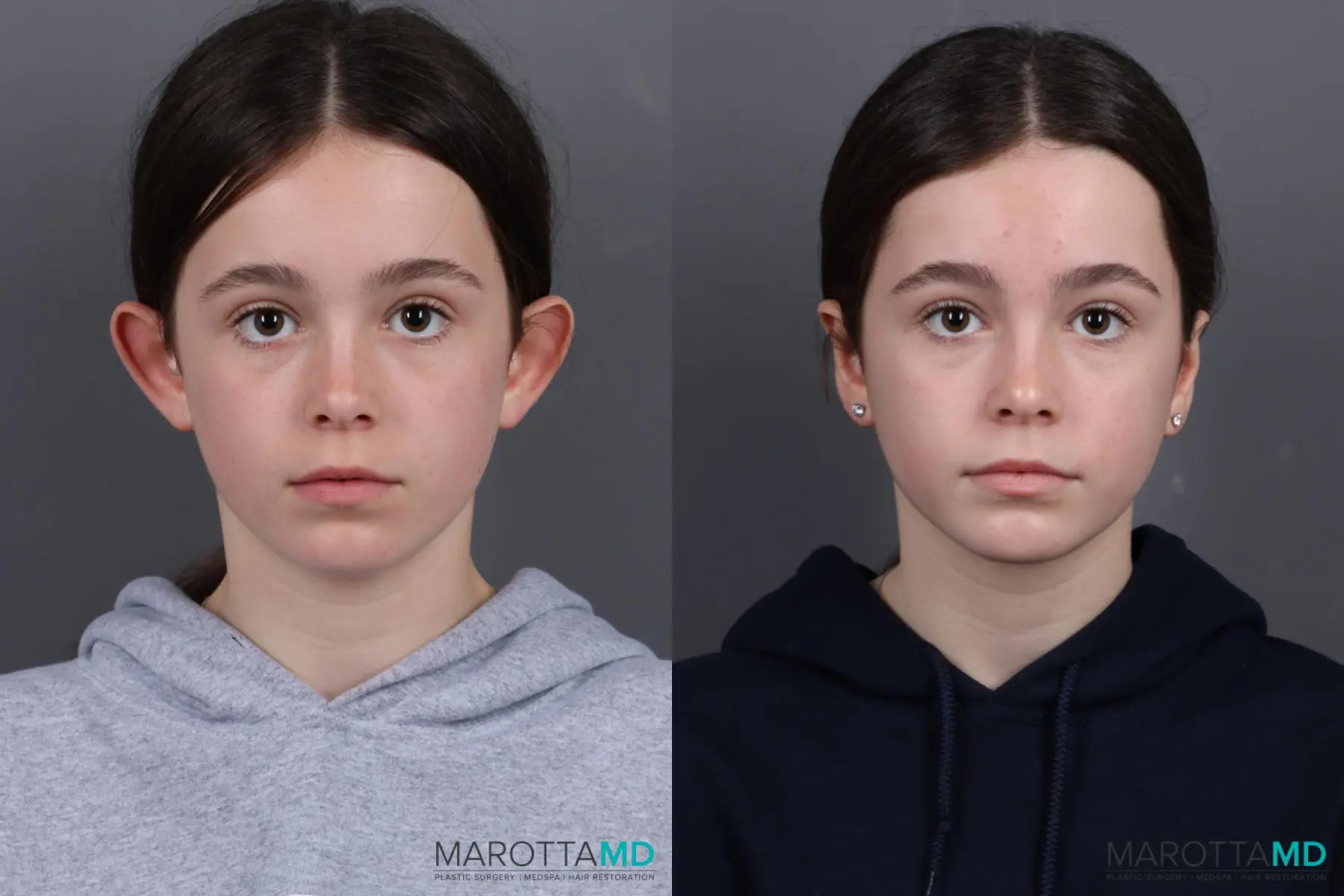 Otoplasty: Patient 1 - Before and After  