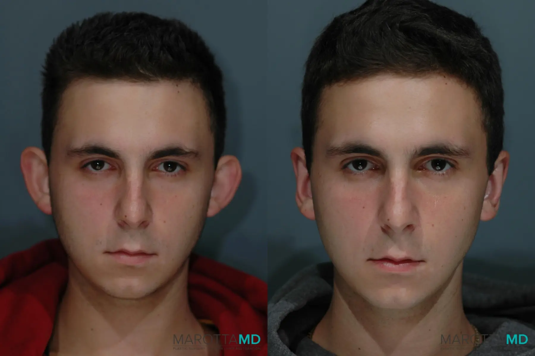 Otoplasty: Patient 2 - Before and After  