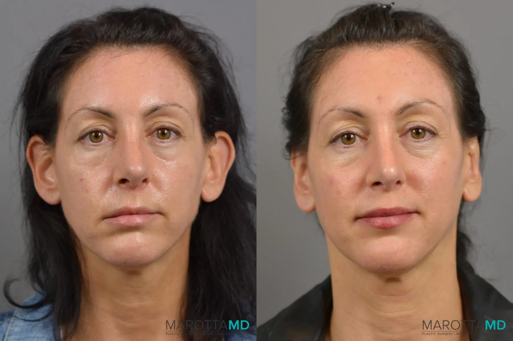 Otoplasty: Patient 1 - Before and After  