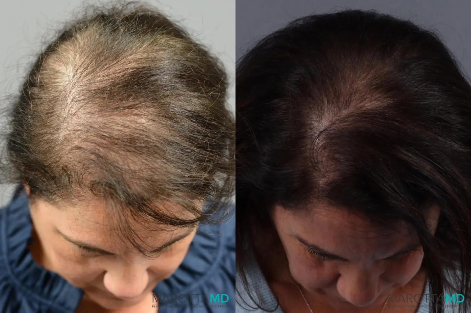 PRP Scalp Treatment: Patient 3 - Before and After  