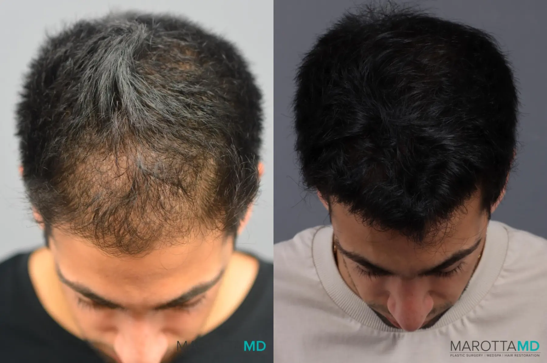 PRP Scalp Treatment: Patient 2 - Before and After  