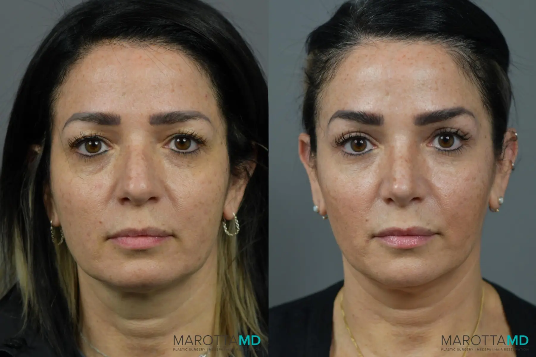 Rhinoplasty: Patient 7 - Before and After  