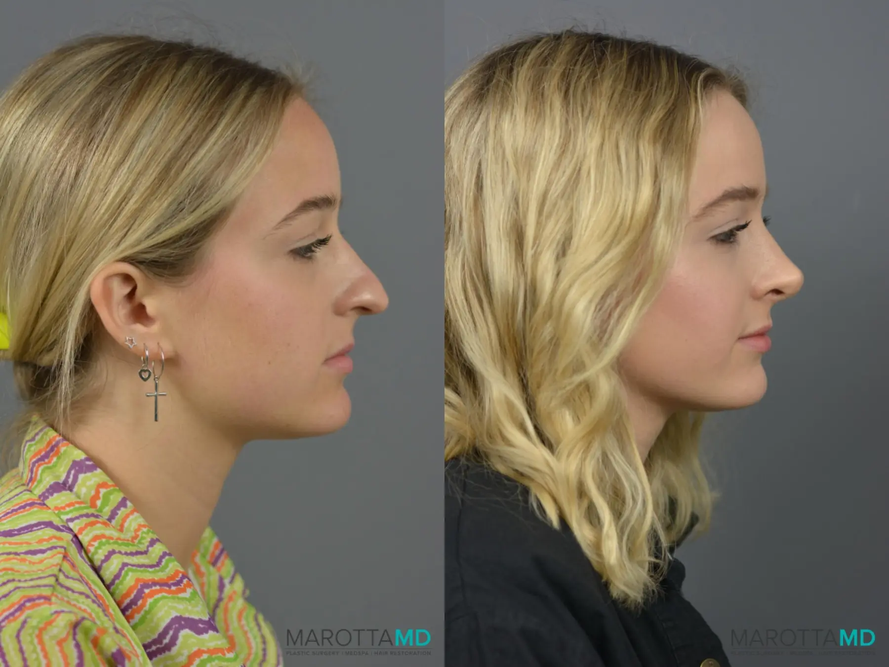 Rhinoplasty: Patient 2 - Before and After  