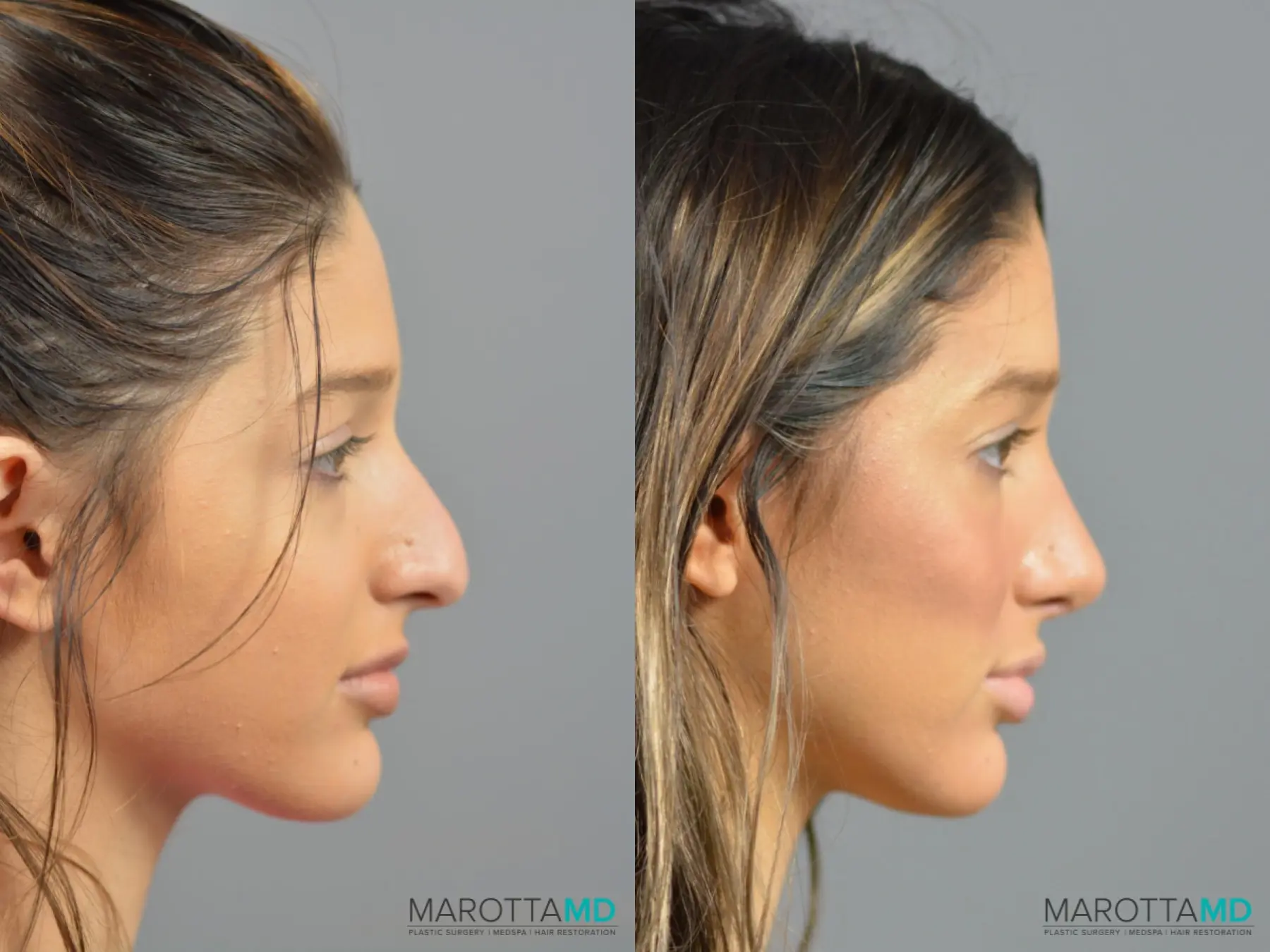 Rhinoplasty: Patient 3 - Before and After  