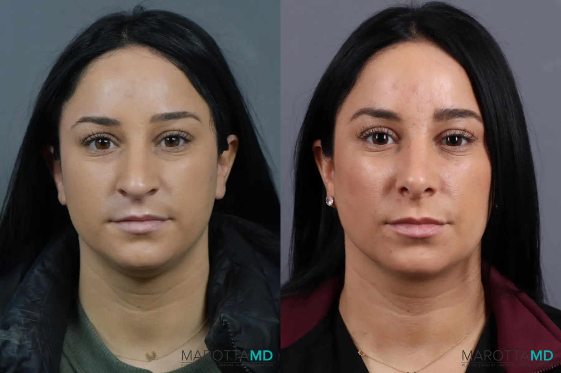 Rhinoplasty: Patient 8 - Before and After  