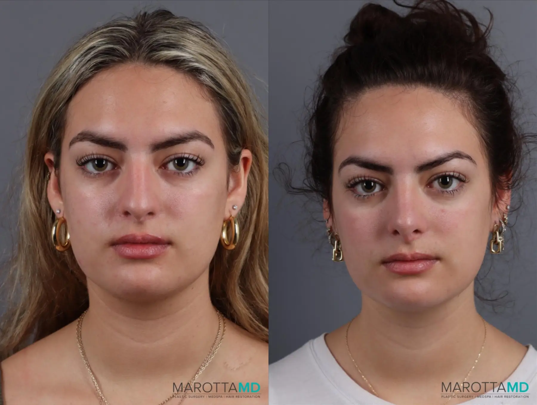 Rhinoplasty: Patient 9 - Before and After  