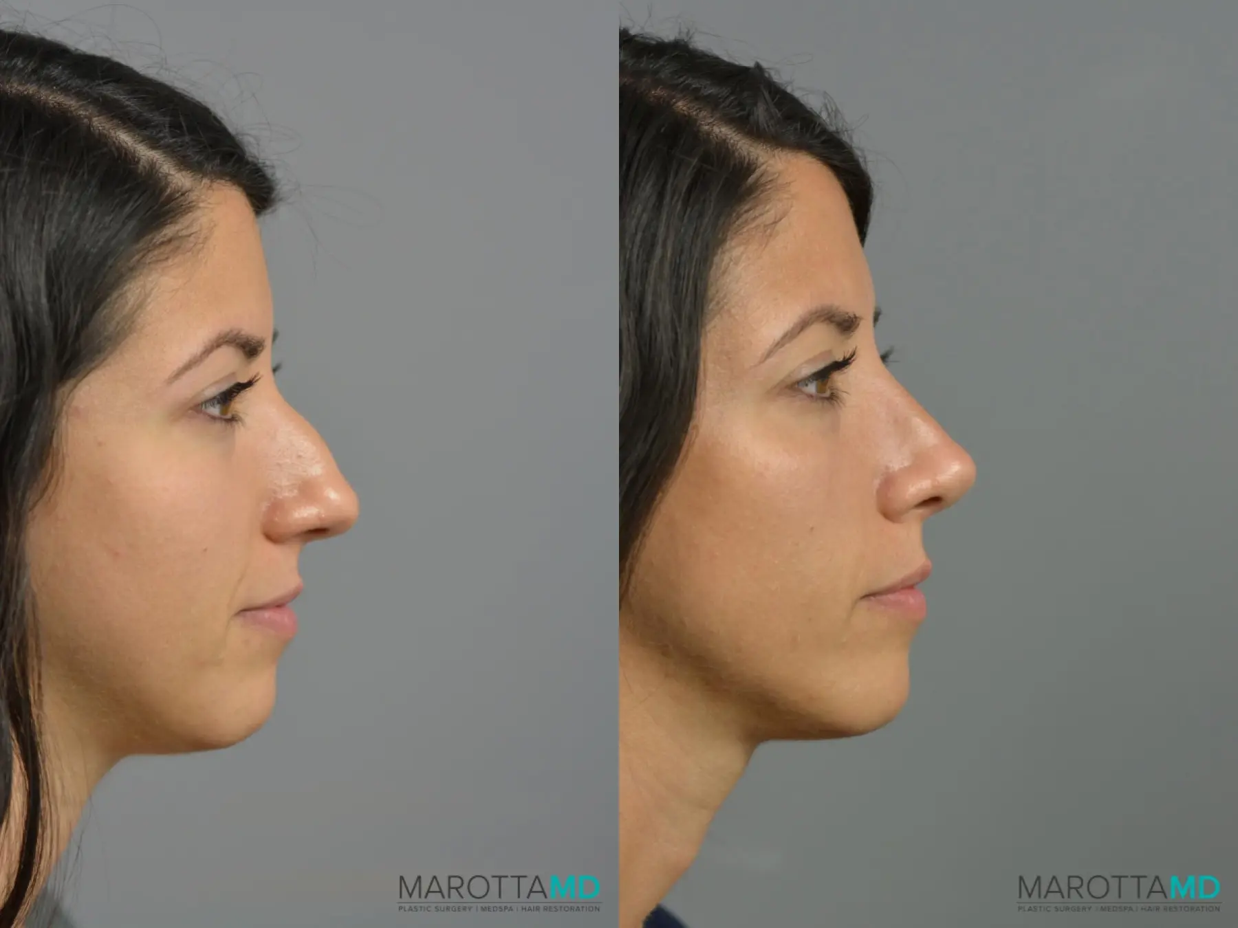 Rhinoplasty: Patient 4 - Before and After  