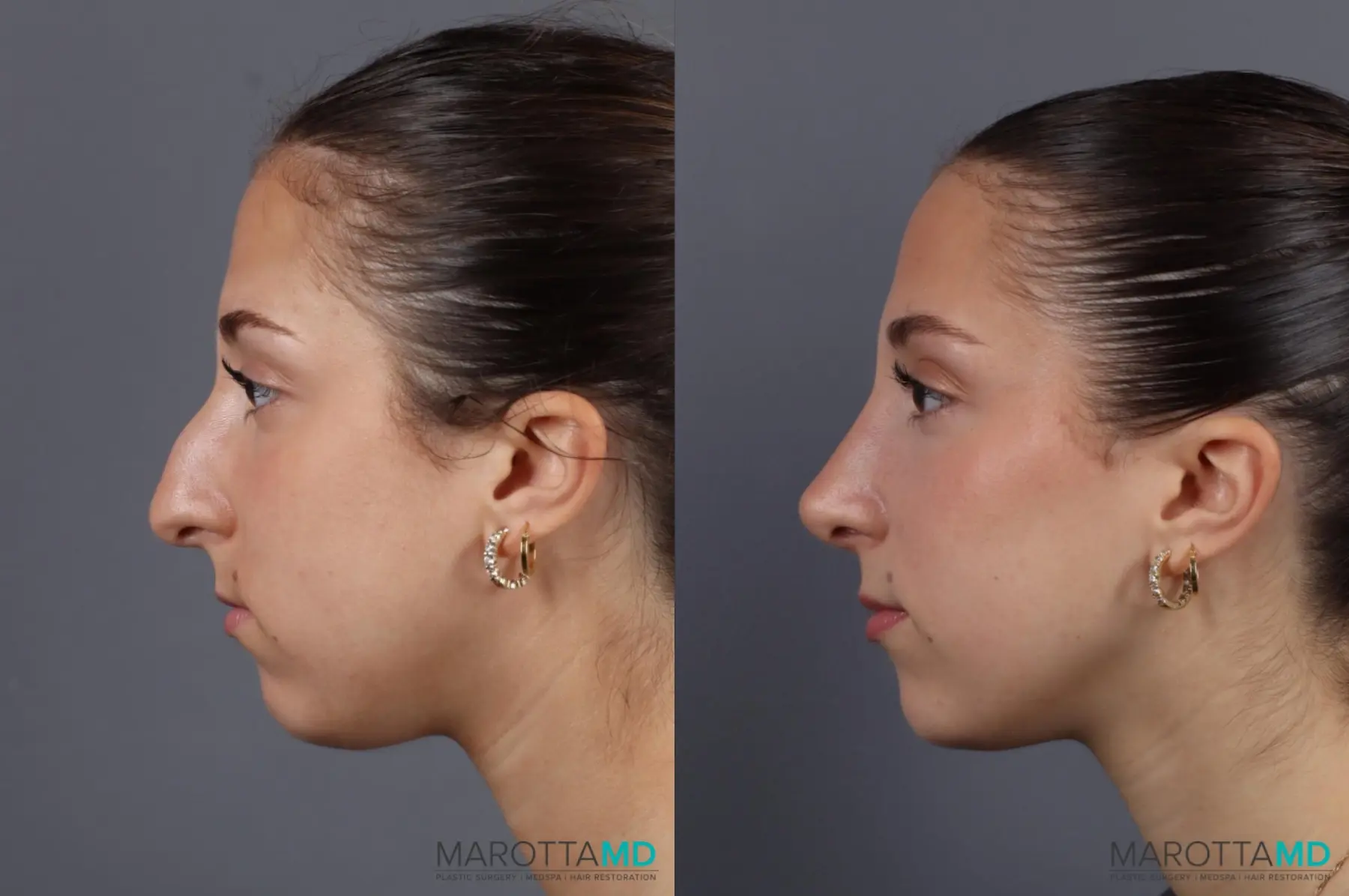 Rhinoplasty: Patient 8 - Before and After  