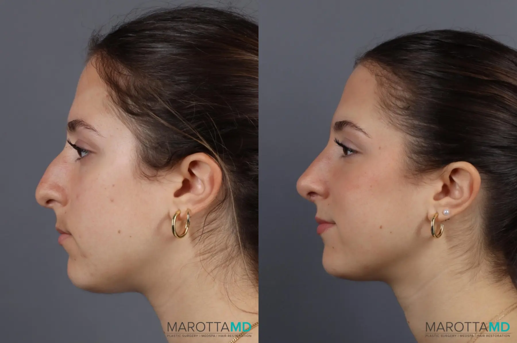 Rhinoplasty: Patient 7 - Before and After  