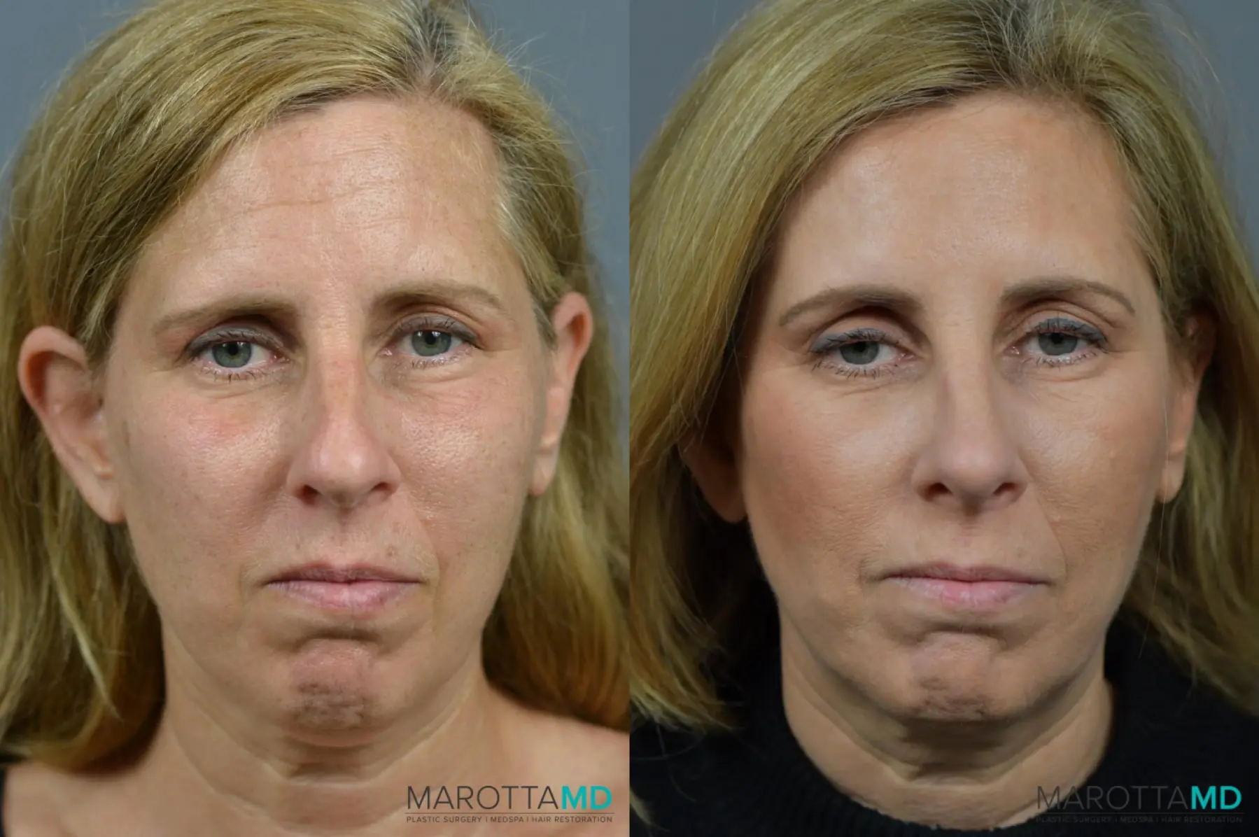 Rhinoplasty: Patient 10 - Before and After  