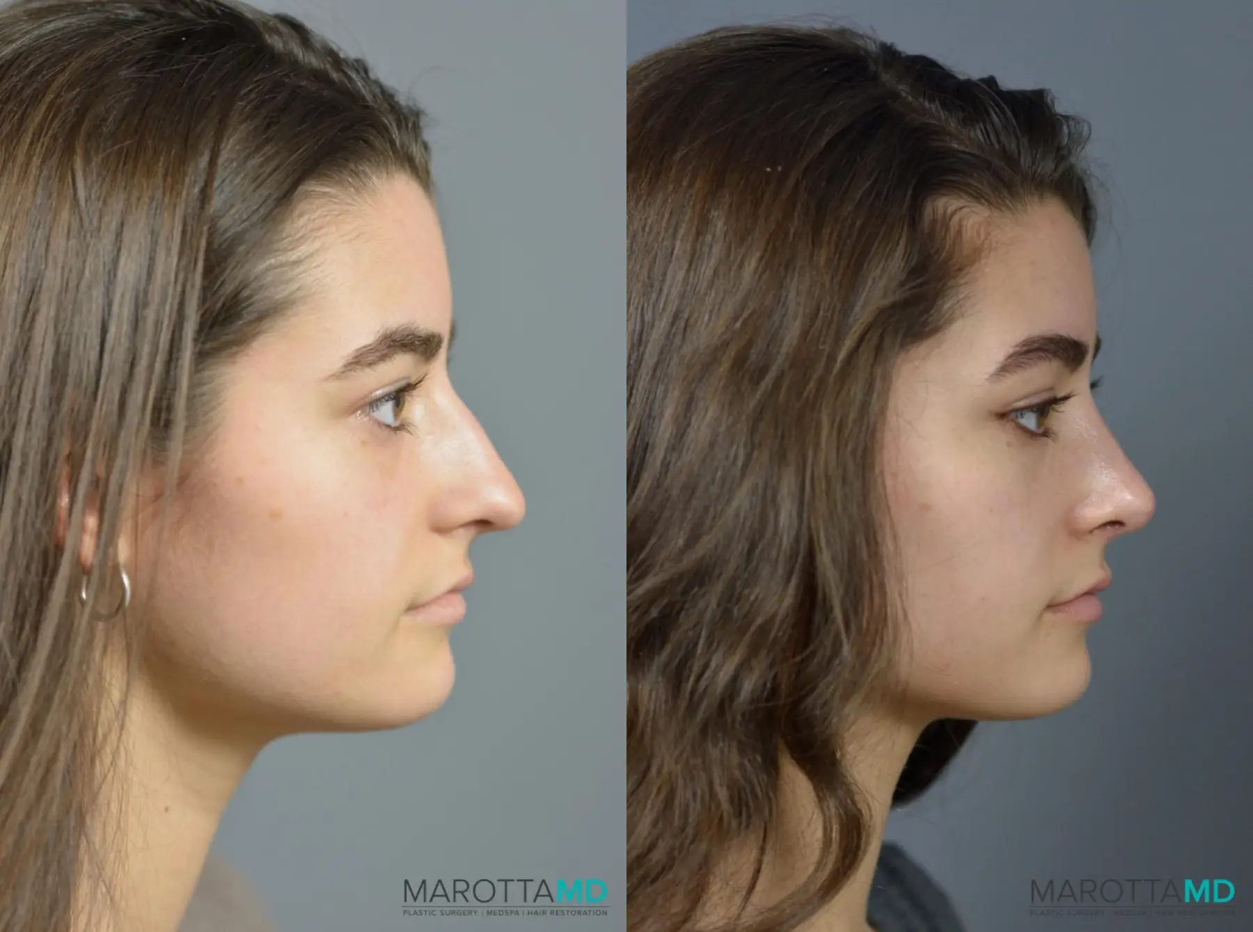 Rhinoplasty: Patient 1 - Before and After  