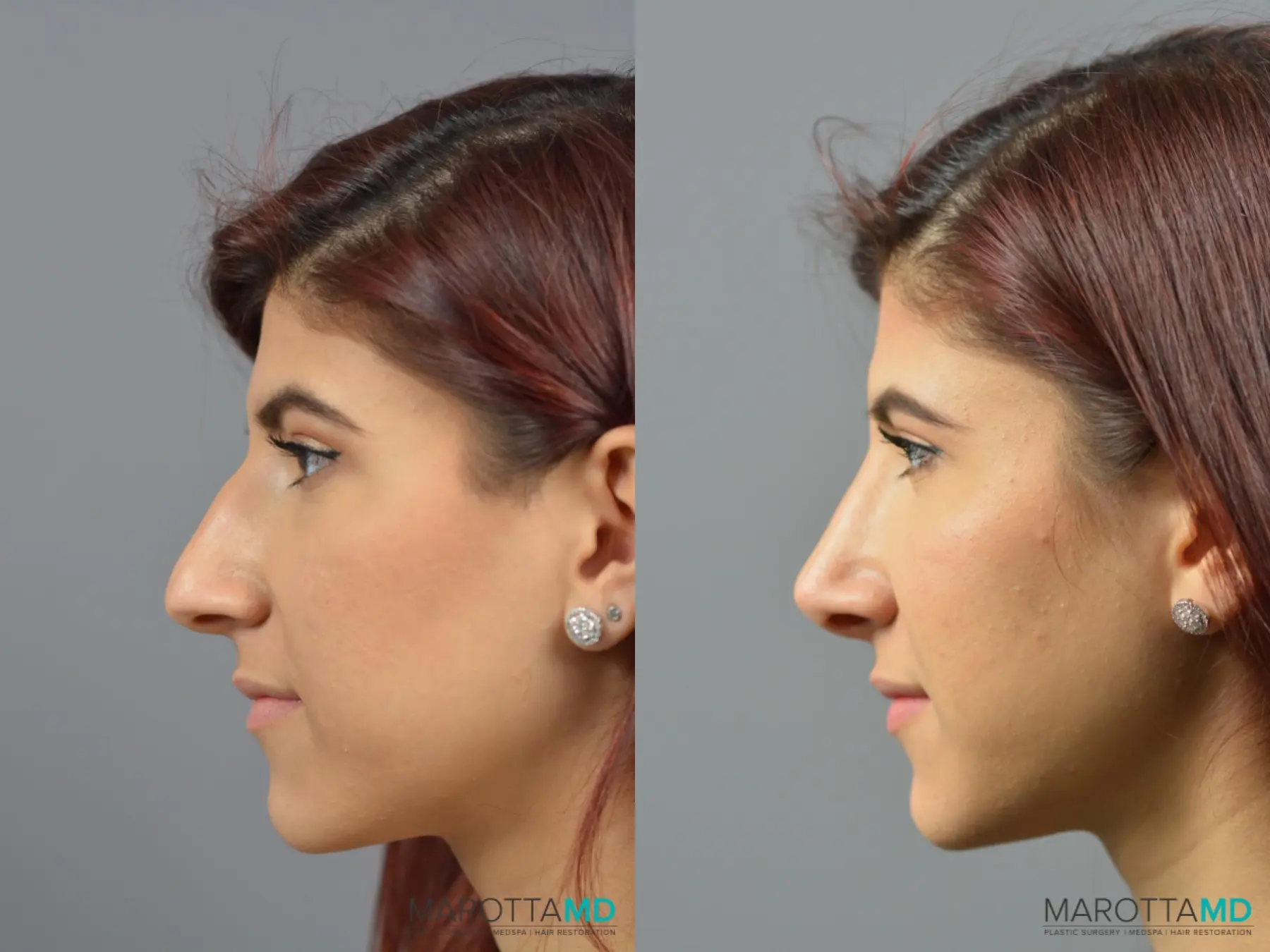 Rhinoplasty: Patient 5 - Before and After  