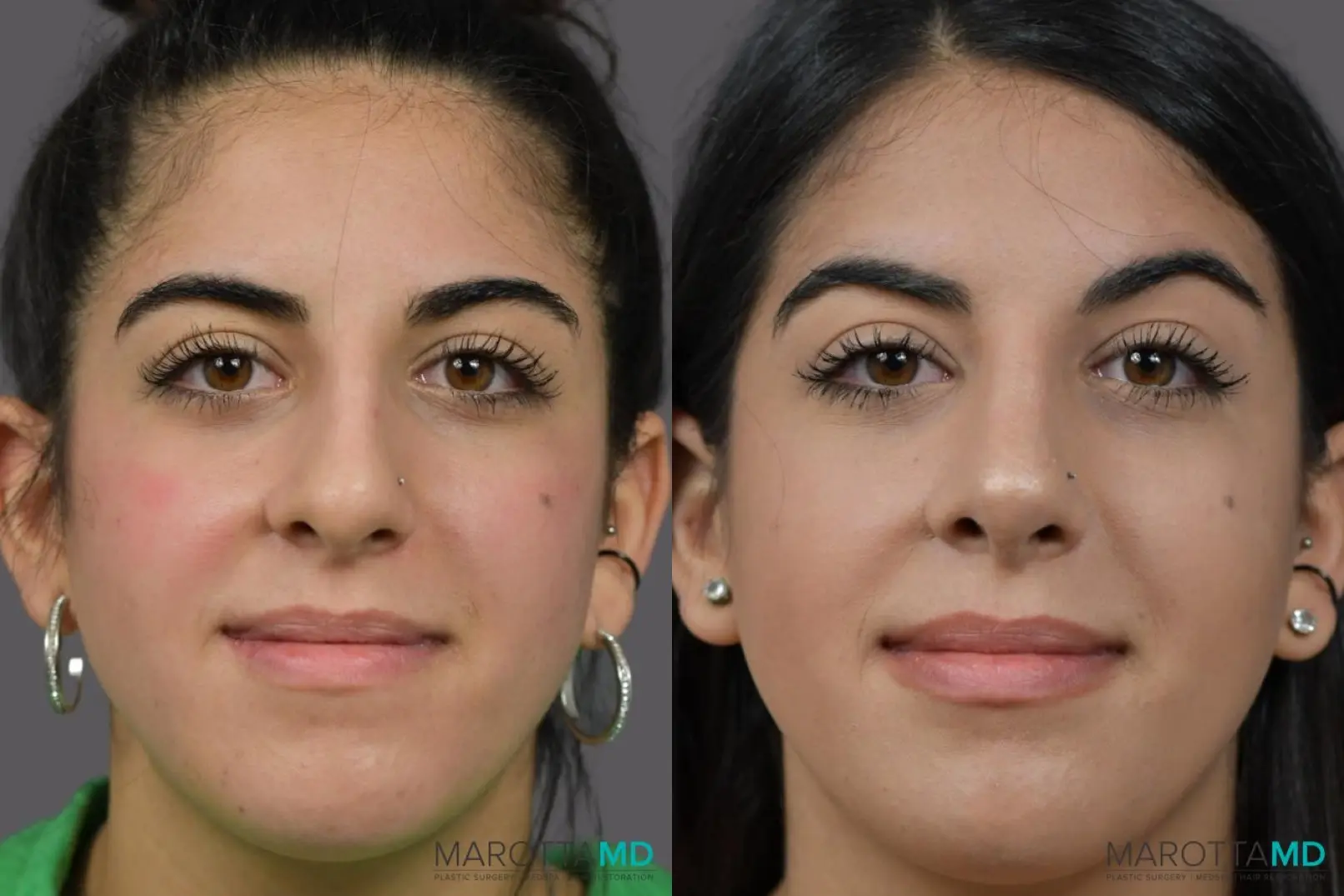 Rhinoplasty: Patient 6 - Before and After  