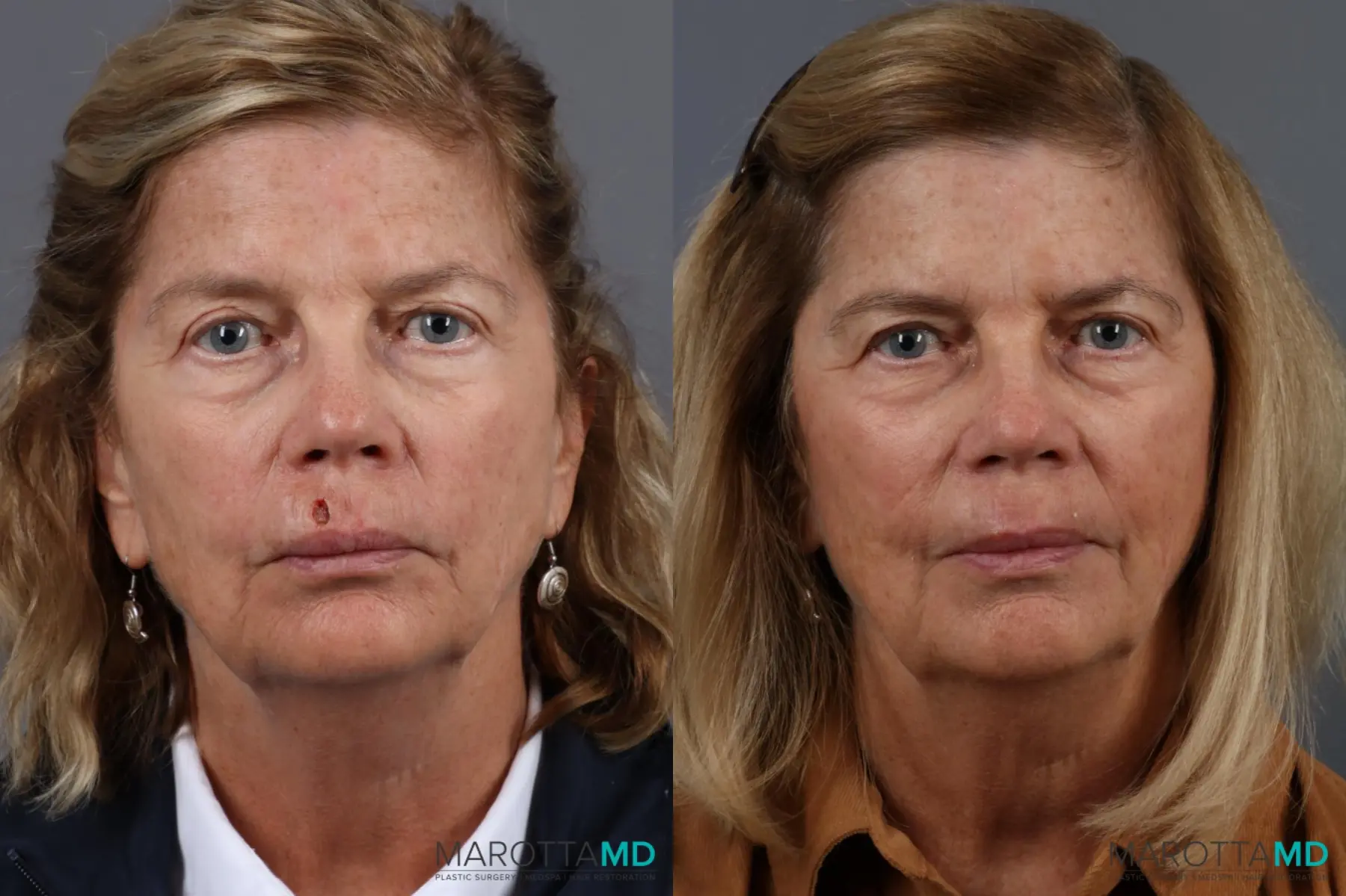 Skin Cancer Reconstruction - Face: Patient 1 - Before and After  