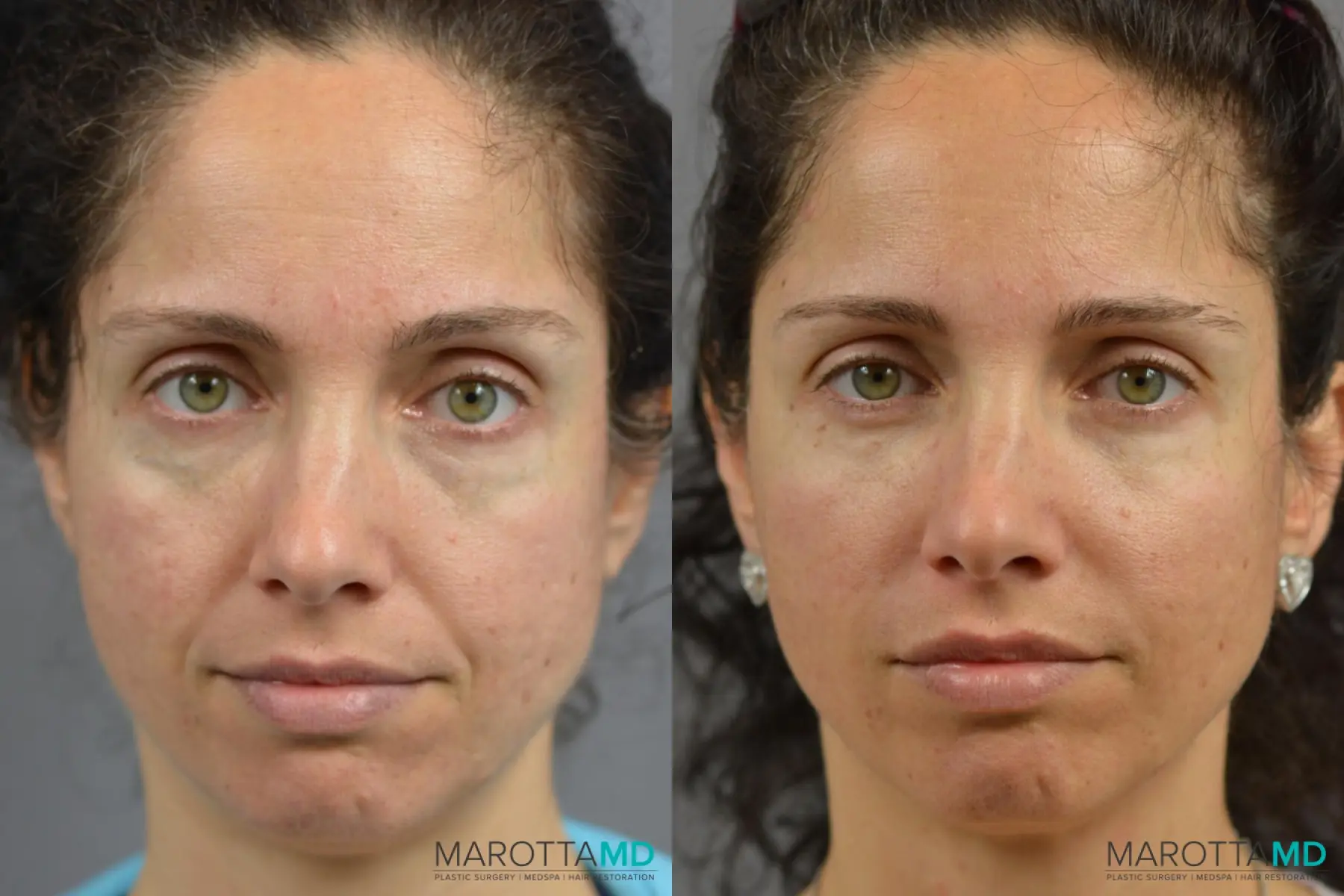 Ultherapy®: Patient 2 - Before and After  