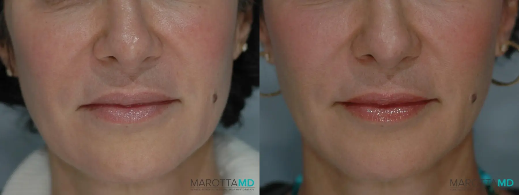 Ultherapy®: Patient 3 - Before and After  