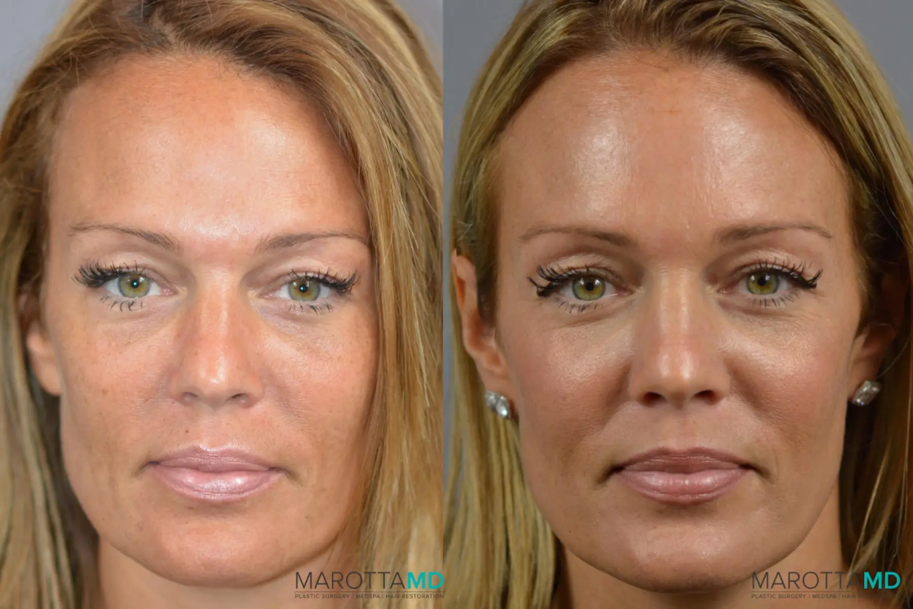 Ultherapy®: Patient 1 - Before and After  