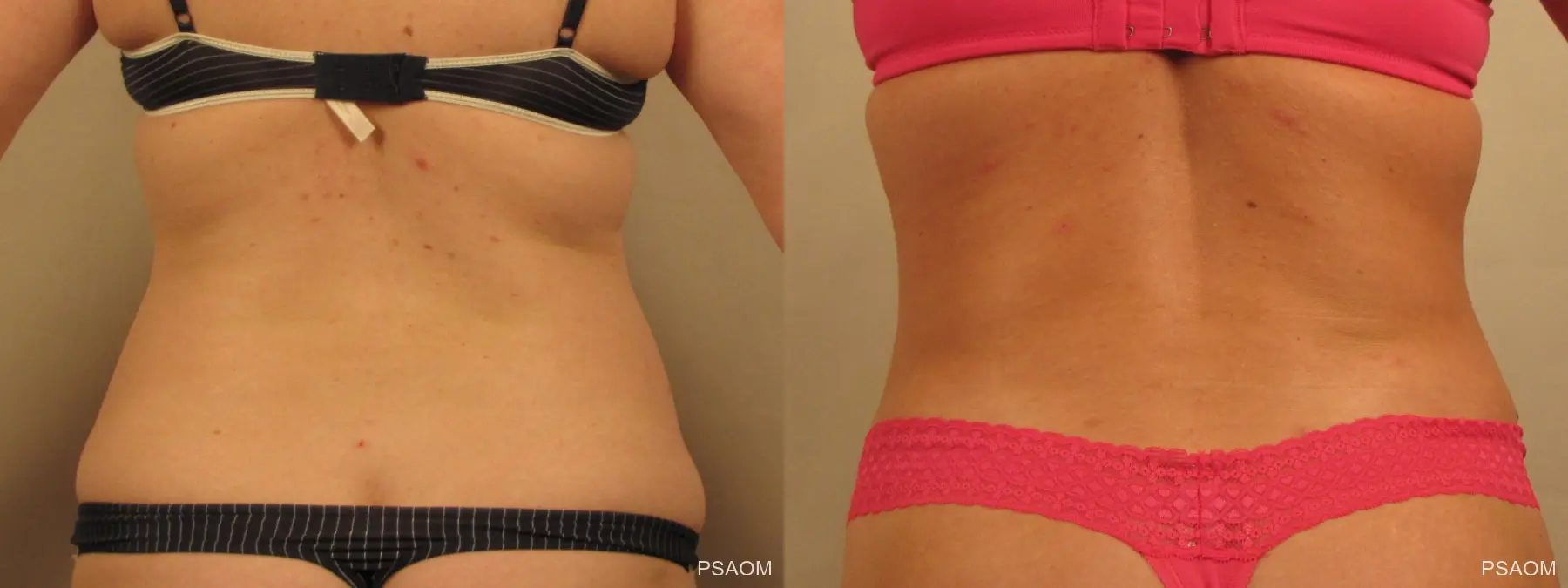 Liposuction, Fat Removal Montgomery
