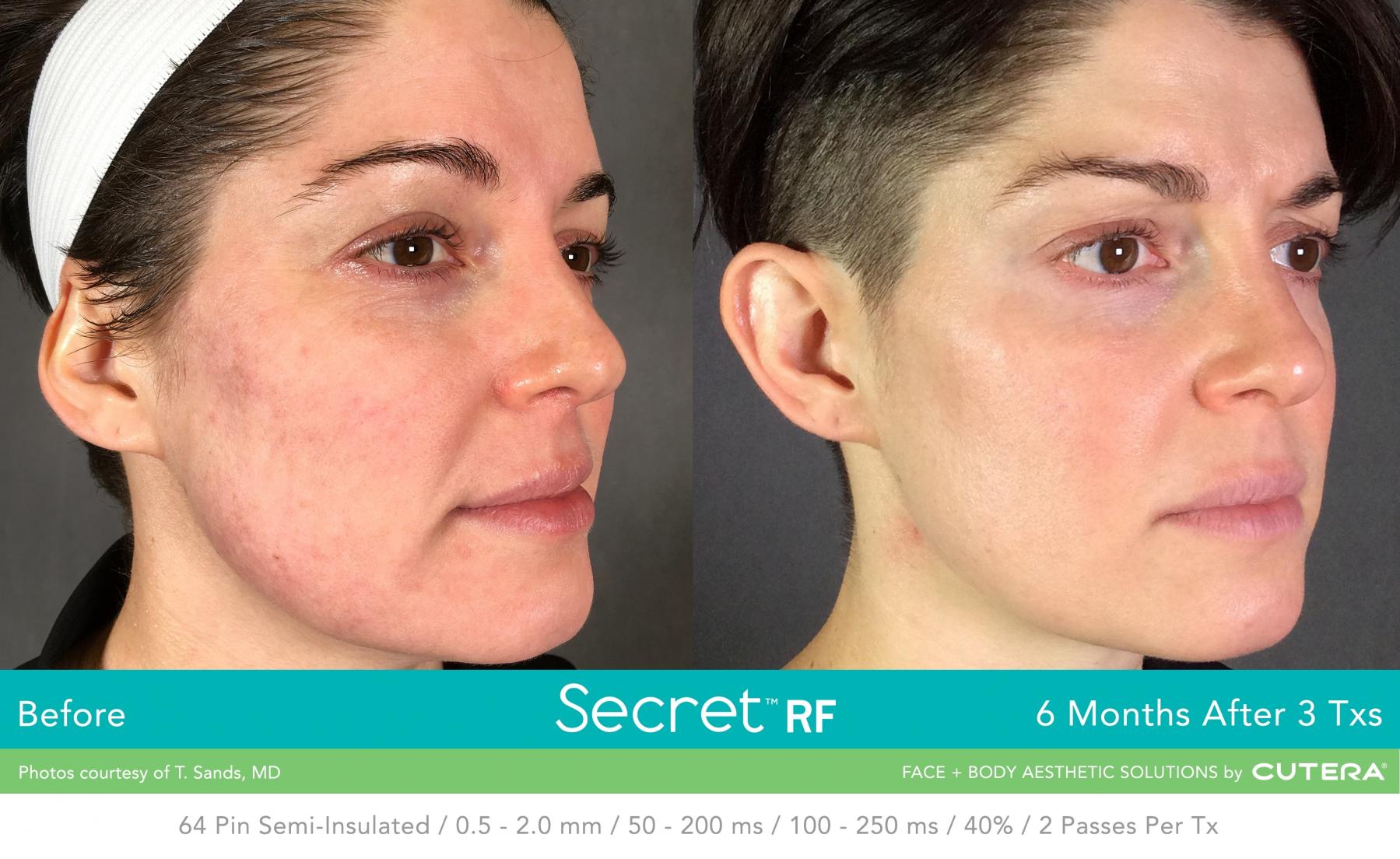 Secret RF: Patient 29 - Before and After 1