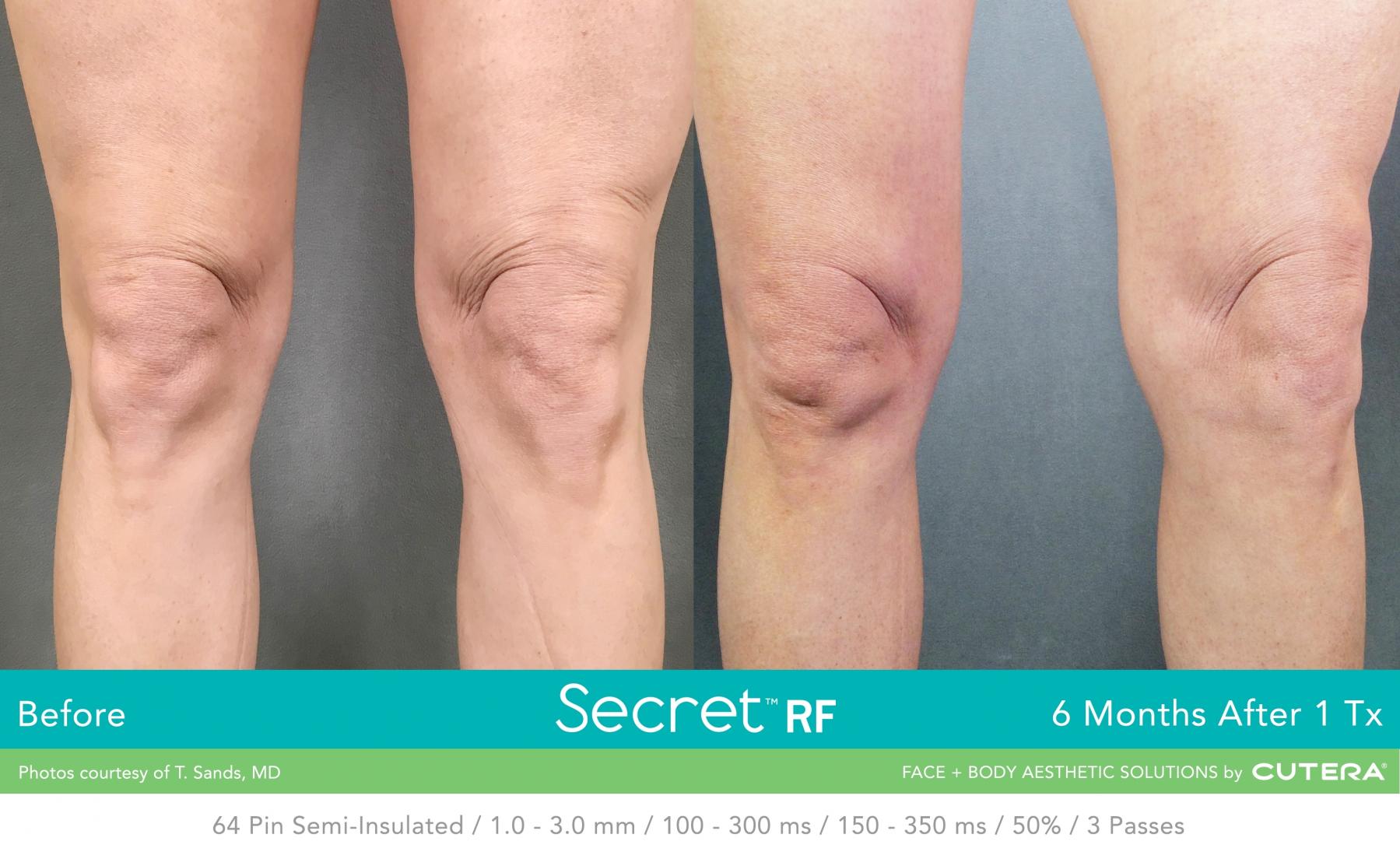 Secret RF: Patient 27 - Before and After 1