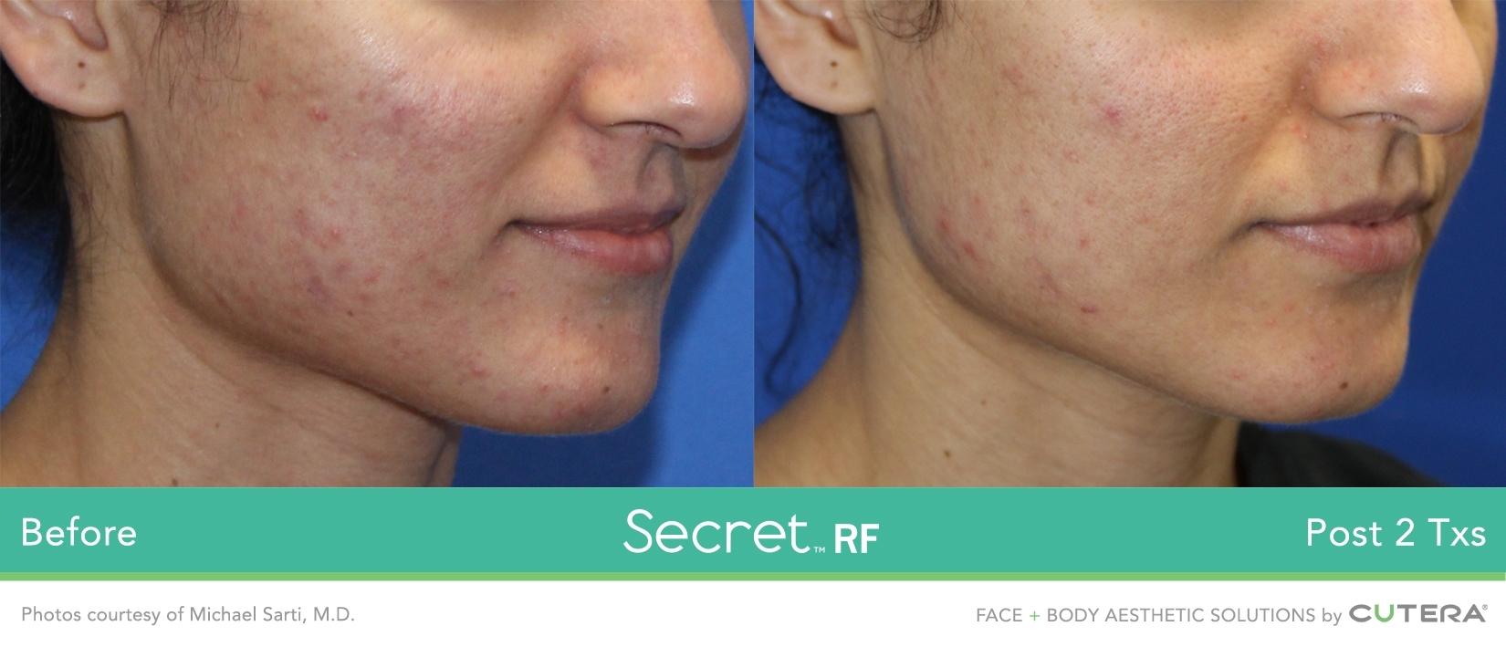 Secret RF: Patient 18 - Before and After 1