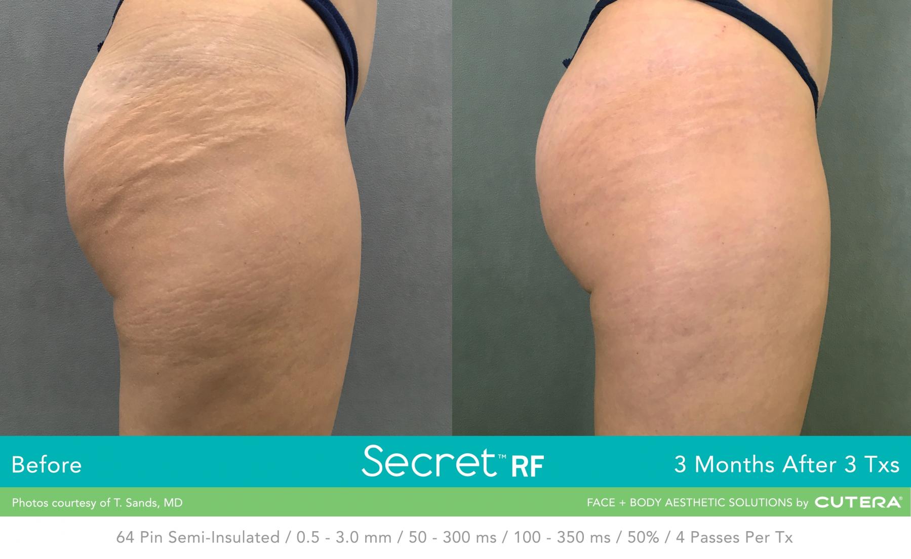 Secret RF: Patient 28 - Before and After 1